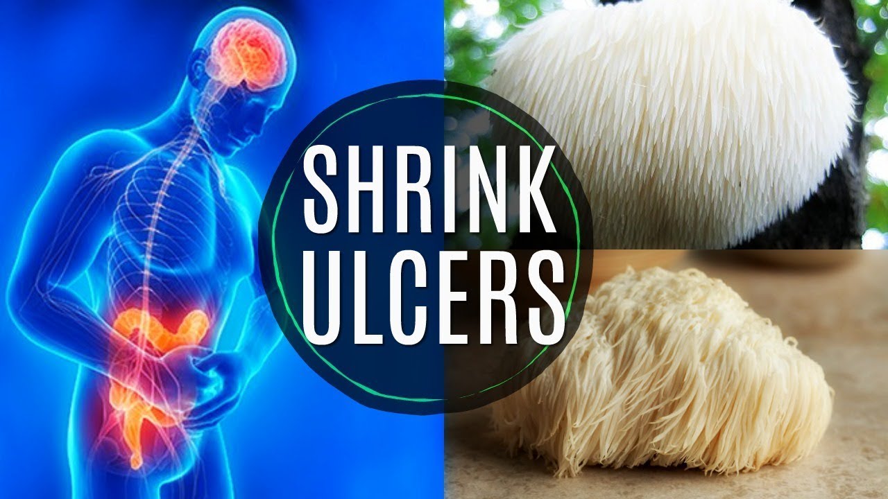 Natural Ulcer Treatment | This Food LITERALLY Shrinks Ulcers - YouTube