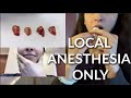 Getting ALL 4 WISDOM TEETH Removed (NO GENERAL ANESTHESIA!!)