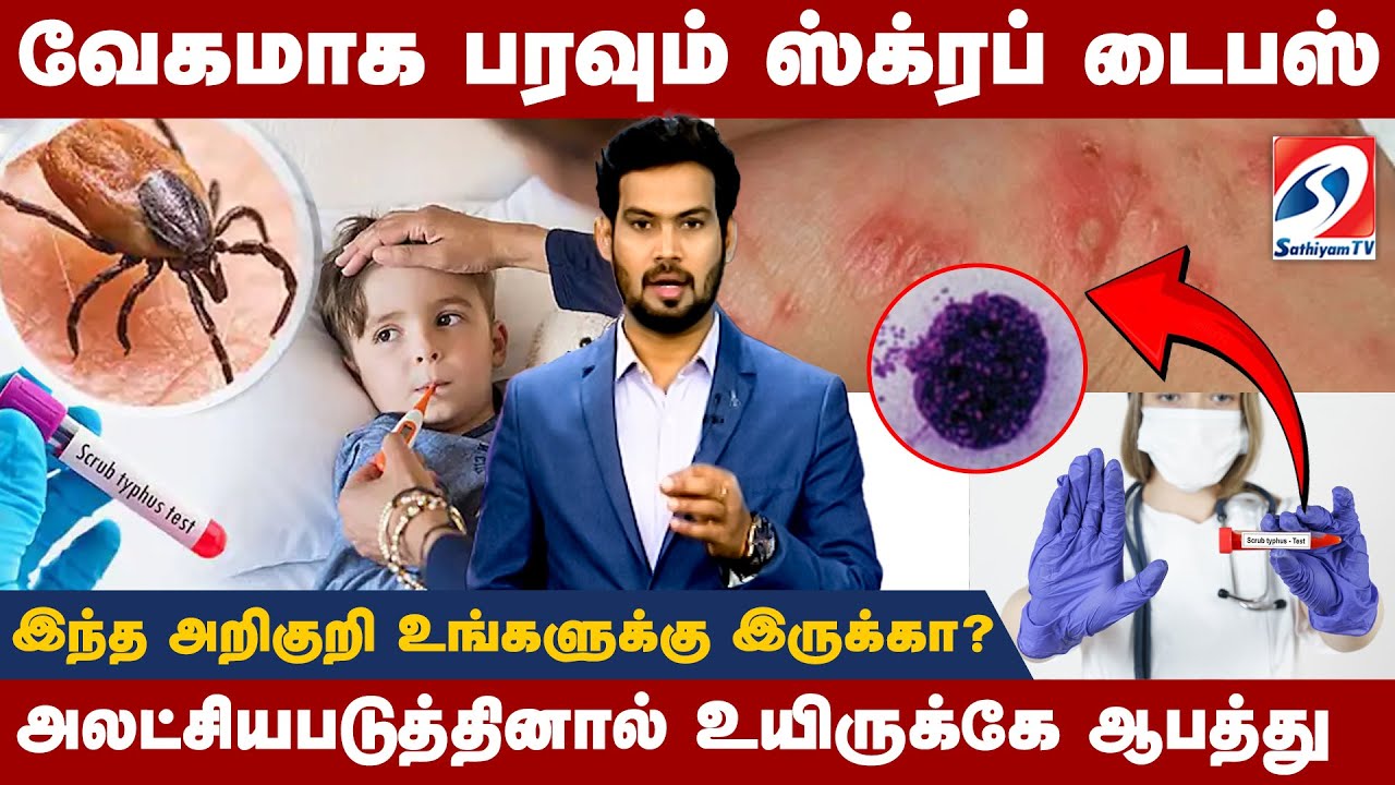 Scrub Typhus Disease || Full Datails || வேகமாக பரவும் ஸ்க்ரப் டைபஸ்! உயிருக்கே ஆபத்து | Sathiyamtv