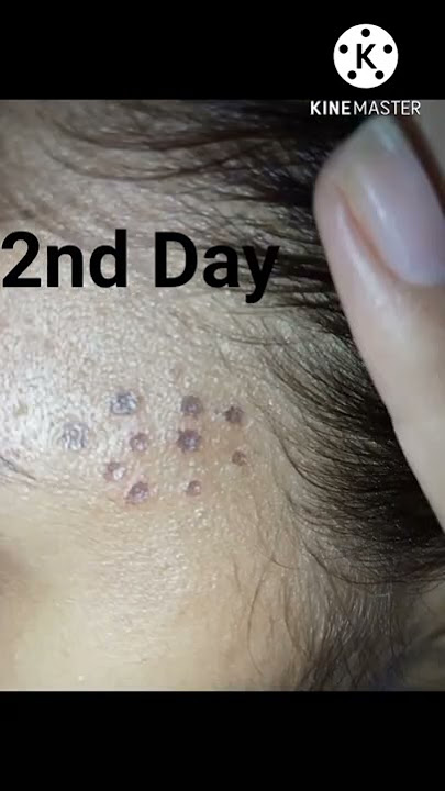 TCA Cross 80%|| Before & After|| 1st Day To 7th Day|| TCA Cross Acne Scars