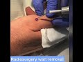 Warts on hand removal by radiosurgery at cosmedics skin clinics london  bristol