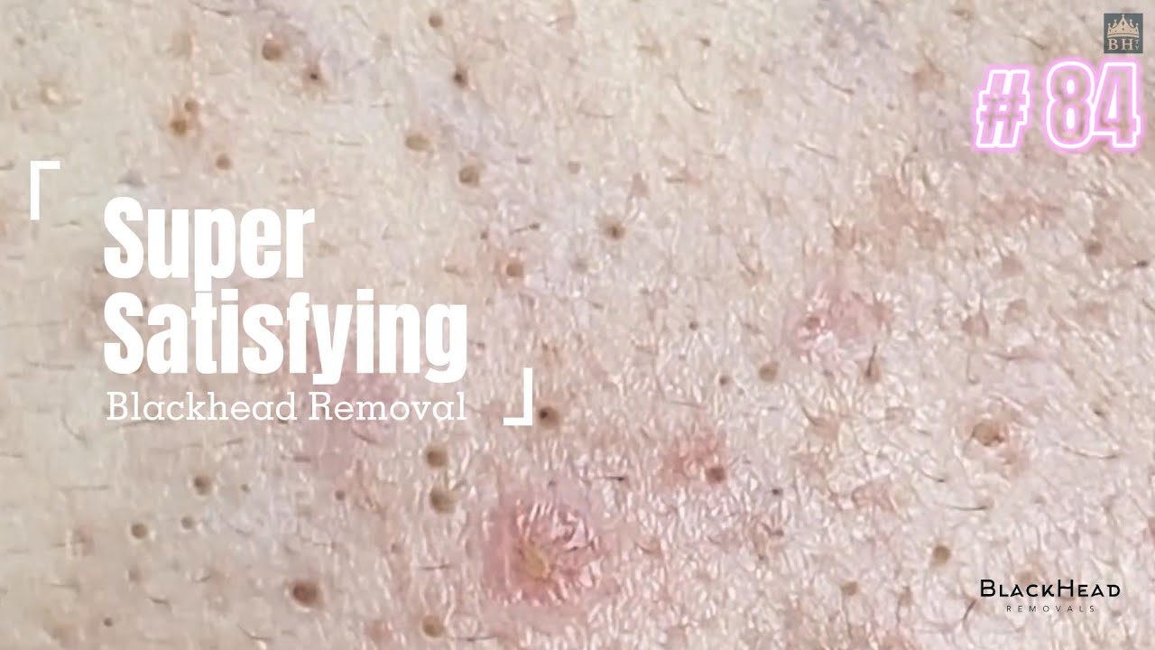 Super Satisfying BLACKHEAD REMOVAL YouTube