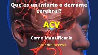 Accidente Cerebrovascular | Escala de Cincinnati