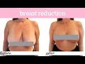 Kathy Visits Lift MD Aesthetics for Breast Reduction Surgery