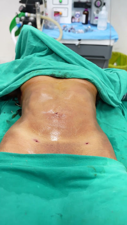 Abdomen Liposuction immediate result #shorts