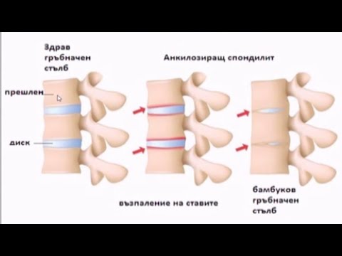 Анкилозиращ спондилит (Болестта на Бехтерев), синдром на Райтер и Сьогрен