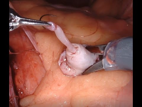 A polyp causing ureteropelvic junction obstruction