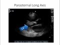 Stroke volume application: an ICU case example