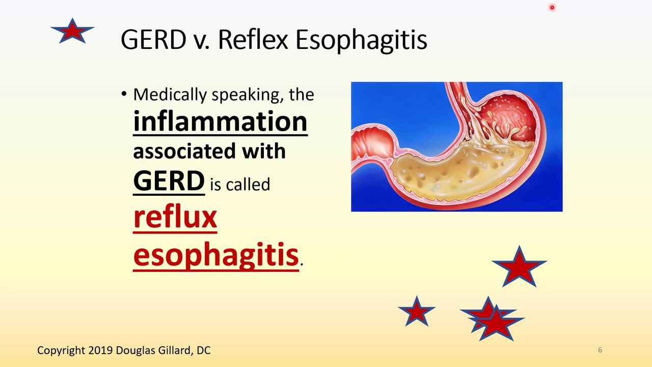 Gastroesophageal reflux disease without oesophagitis