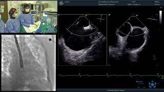 Multi Fenestre Asd Kapama Vakası Dr Hakan Güllü