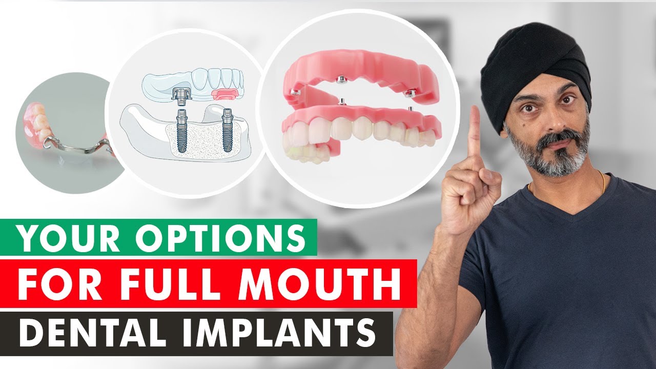 Замена всех зубов: какое решение по имплантации подойдет именно вам?