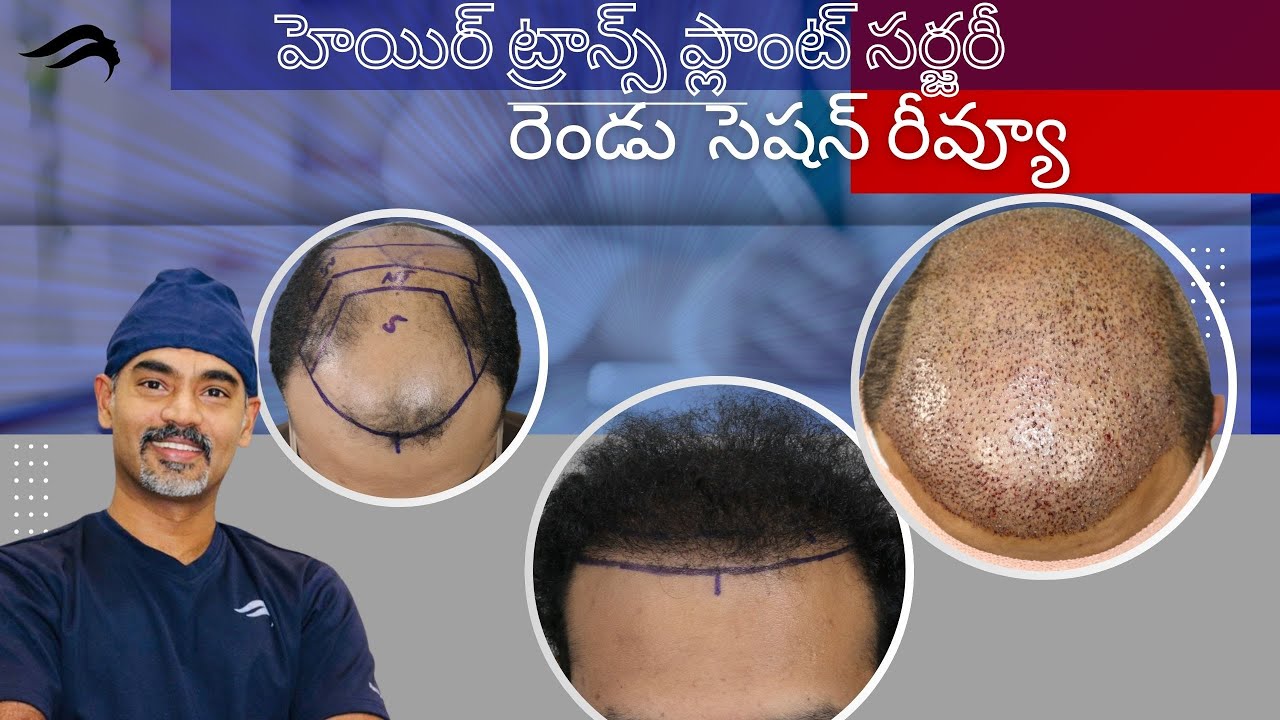 Hair Transplant In Hyderabad | Best Centre Results & Surgeon Of Hair Transplant Surgery In Hyderabad