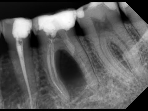 Антибиотики в стоматологии Лечение кисты зуба Имплантация зубов Обострение периодонтита. Эндодонтист