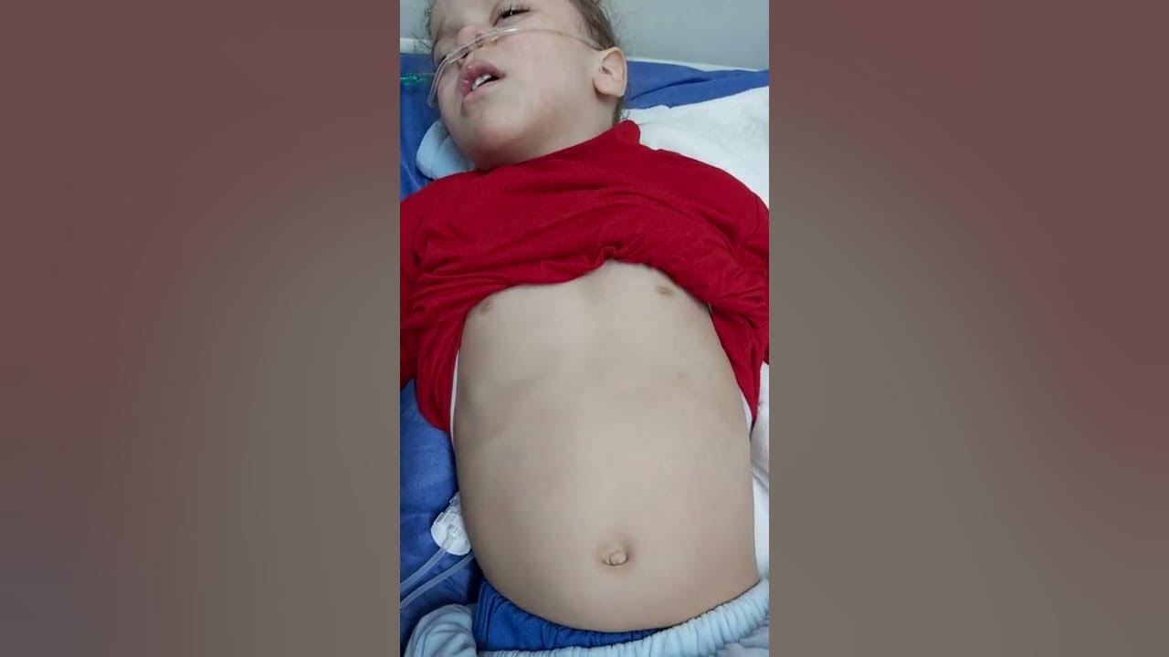 Physical examination, subcostal, intercostal retraction, respiratory