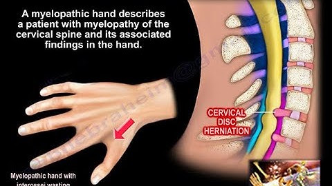 Compression of the Spinal Cord & Hand Function - Everything You Need To Know - Dr. Nabil Ebraheim