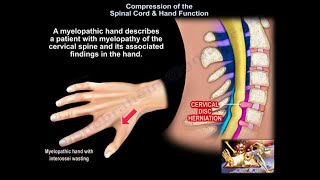 Compression of the Spinal Cord & Hand Function - Everything You Need To Know - Dr. Nabil Ebraheim