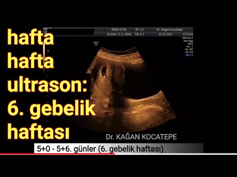 6. gebelik haftasında anne karnındaki bebek - açıklamalı ultrason görüntüleri