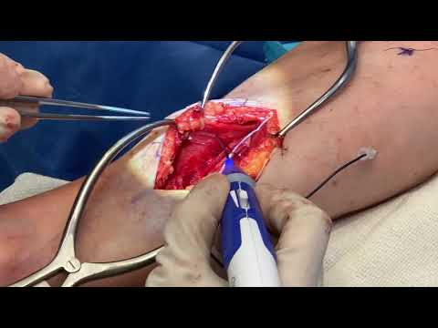 Intraoperative Checkpoint Stimulation for TMR, Neurolysis & Denervations (Dr. Edgardo Rodriguez)