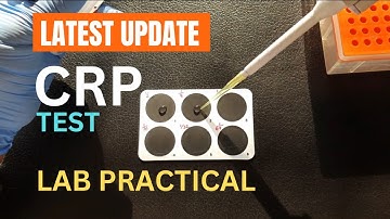 CRP test | C reactive protein test | Procedure
