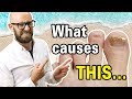What Causes Toenails to Turn Yellow?
