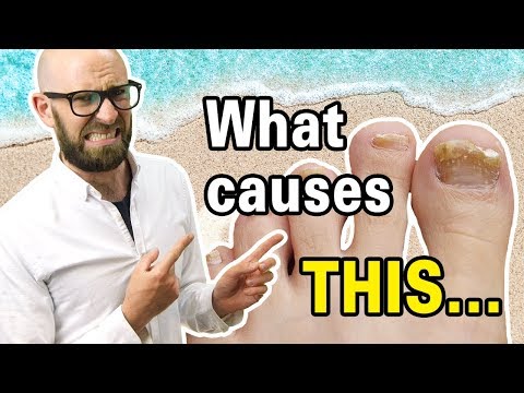 Видео: Почему Toenails Turn Yellow