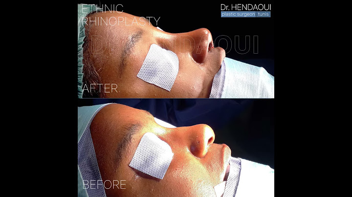 Rhinoplastie ethnique en Tunisie: avant après