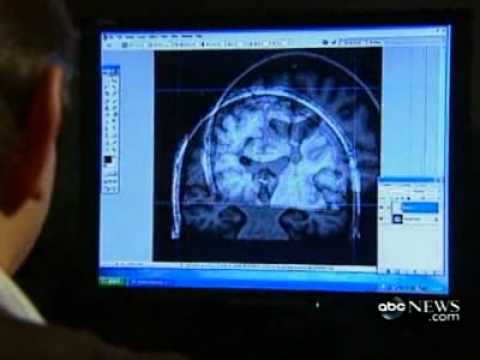 Video: Smegenų Magnetinė Stimuliacija Ištrino Nemalonius Prisiminimus - Alternatyvus Vaizdas