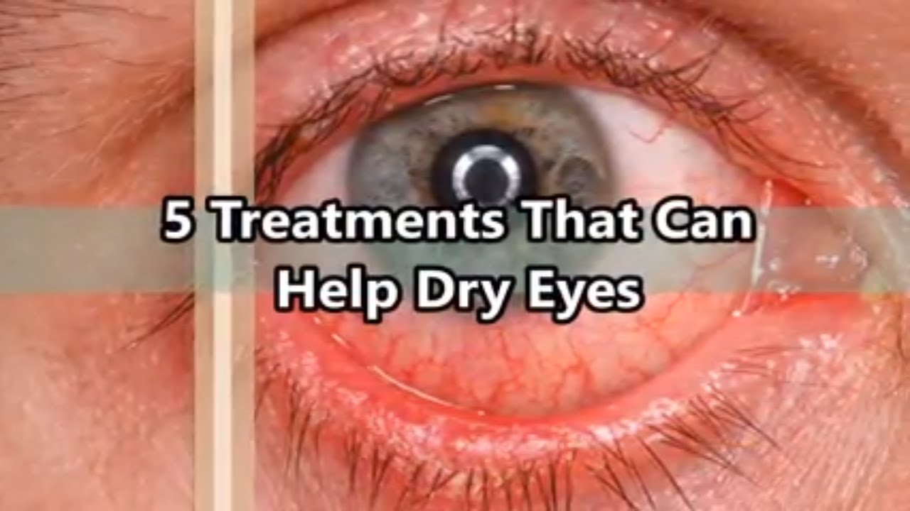 5 Treatments That Can Help Dry Eyes - YouTube