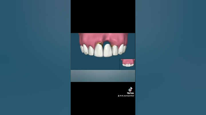Dişleri keserek köprünnün sonu #laminediş #zirkonyumkaplama #dentistry #zirkonia #dentist