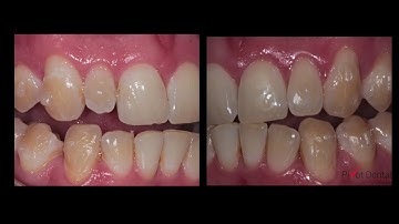 Invisalign Laterals Not Tracking