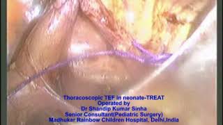 Thoracoscopic tef repair-TREAT by Dr Shandip Sinha,Pediatric Surgeon