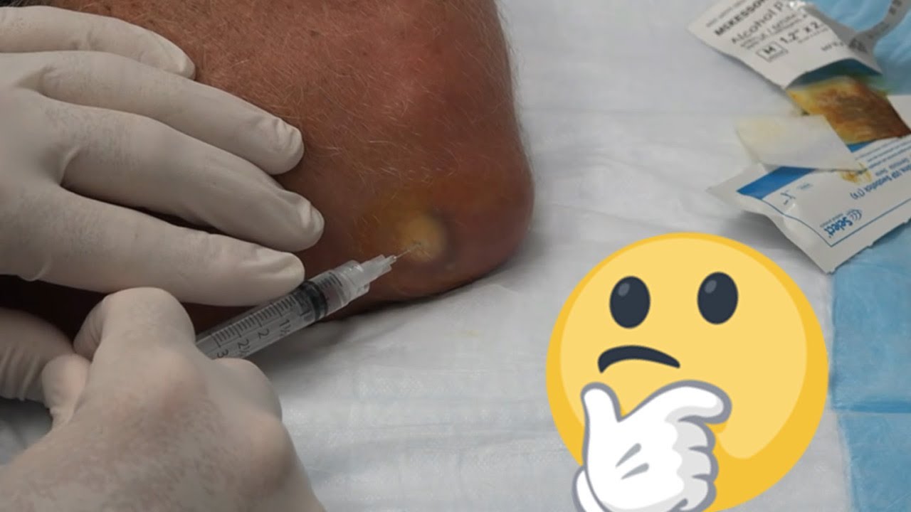 Elbow Effusion Aspiration YouTube