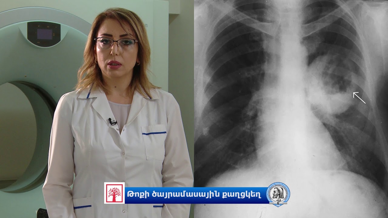 Թոքի ծայրամասային քաղցկեղ