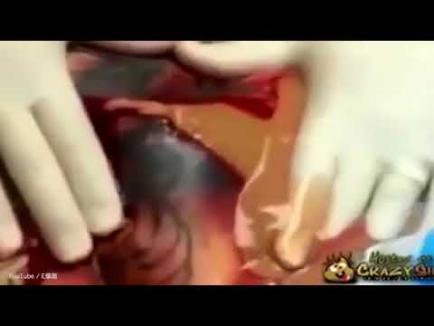 Infected Back Tattoo Youtube