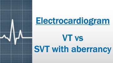 VT versus SVT with aberrancy [Electrocardiogram]