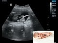 Ultrasound showing baby boy in breech presentation