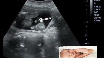 Ultrasound Showing Baby Boy in breech Presentation