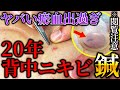 【閲覧注意 ニキビ瘀血出す】瘀血出過ぎ 20年来の背中ニキビ 除去に瘀血だし吸い玉と鍼で治す 自宅でできる方法も伝授 【横浜元町 銀座日本橋 鍼灸院】