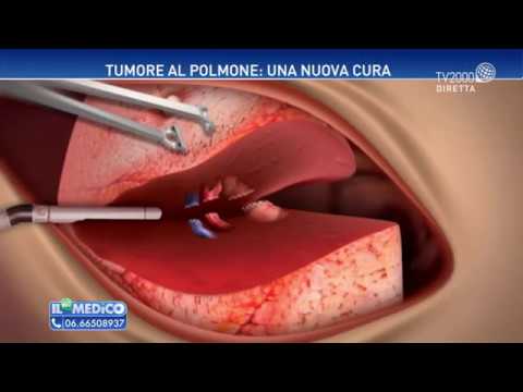 Tumore al pancreas: si può prevenire? - Vivere più sani