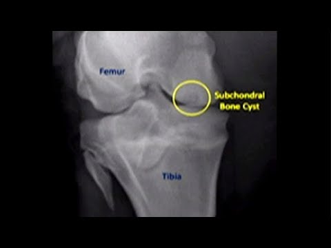 Video: Wat is 'n subchondrale sist?