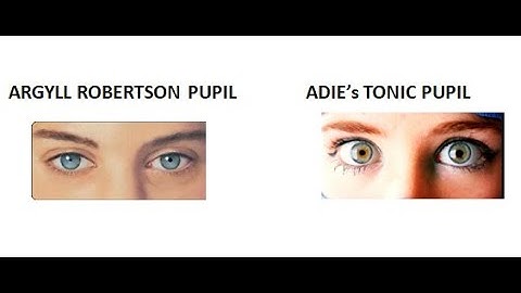 Ophthalmology 326 Argyll robertson pupil Adies tonic pupil neurosyphilis difference pilocarpine test