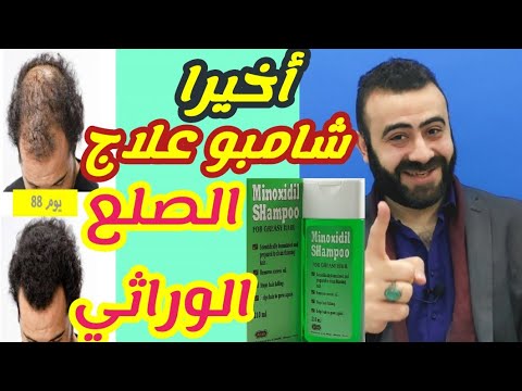 شامبو المينوكسيديل لعلاج الصلع الوراثي - Minoxidil Shampoo - YouTube