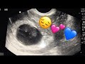 CAN’T CONFIRM HEARTBEAT AT 9 WEEKS// POSSIBLE MISCARRIAGE// MISSED MISCARRIAGE