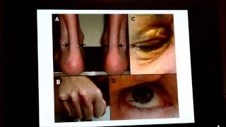 Familial Hypercholesterolemia