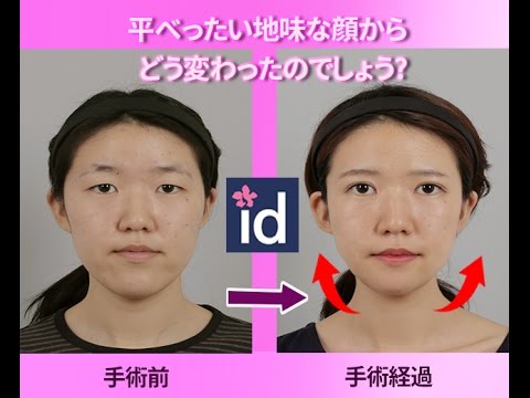 整形で平べったい暗い顔から華やかな顔に激変 日本人女性体験談 Youtube
