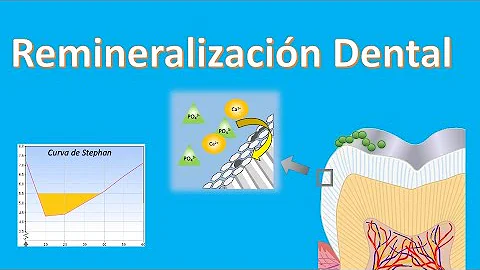 ¿Cómo remineralizan los dentistas los dientes?