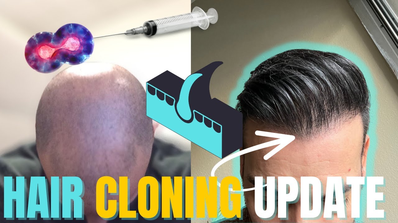 Hair Clone UPDATE - Hair Transplant Network Podcast Episode 19 - YouTube