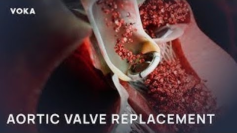 Aortic Valve Replacement: Step-by-Step Open-Heart Surgery 3D Animation