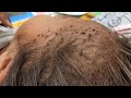 How to remove head lice from short hair  taking out all hundred lice from hair