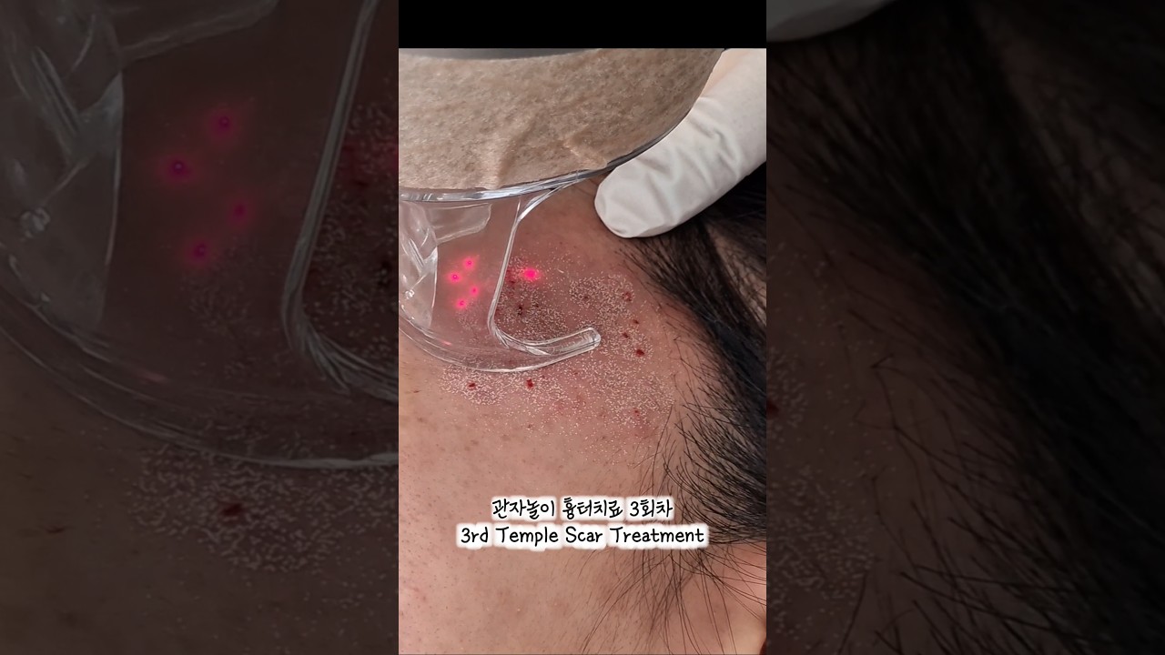 관자놀이 흉터치료 3회차→ 3rd Temple Scar Treatment#acne #여드름흉터치료 #스킨케어 #video